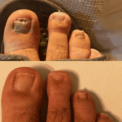 Cureet - Eradicate Nail Fungus